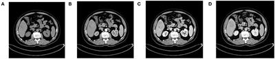 Computed Tomography Radiomics-Based Prediction of Microvascular Invasion in Hepatocellular Carcinoma